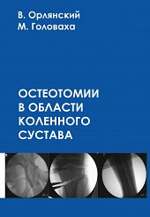 Остеотомии в области коленного сустава