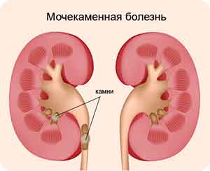 Как развивается мочекаменная болезнь