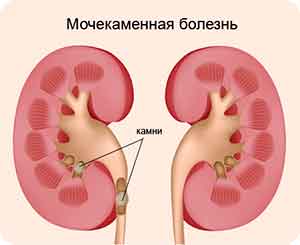 Как развивается мочекаменная болезнь